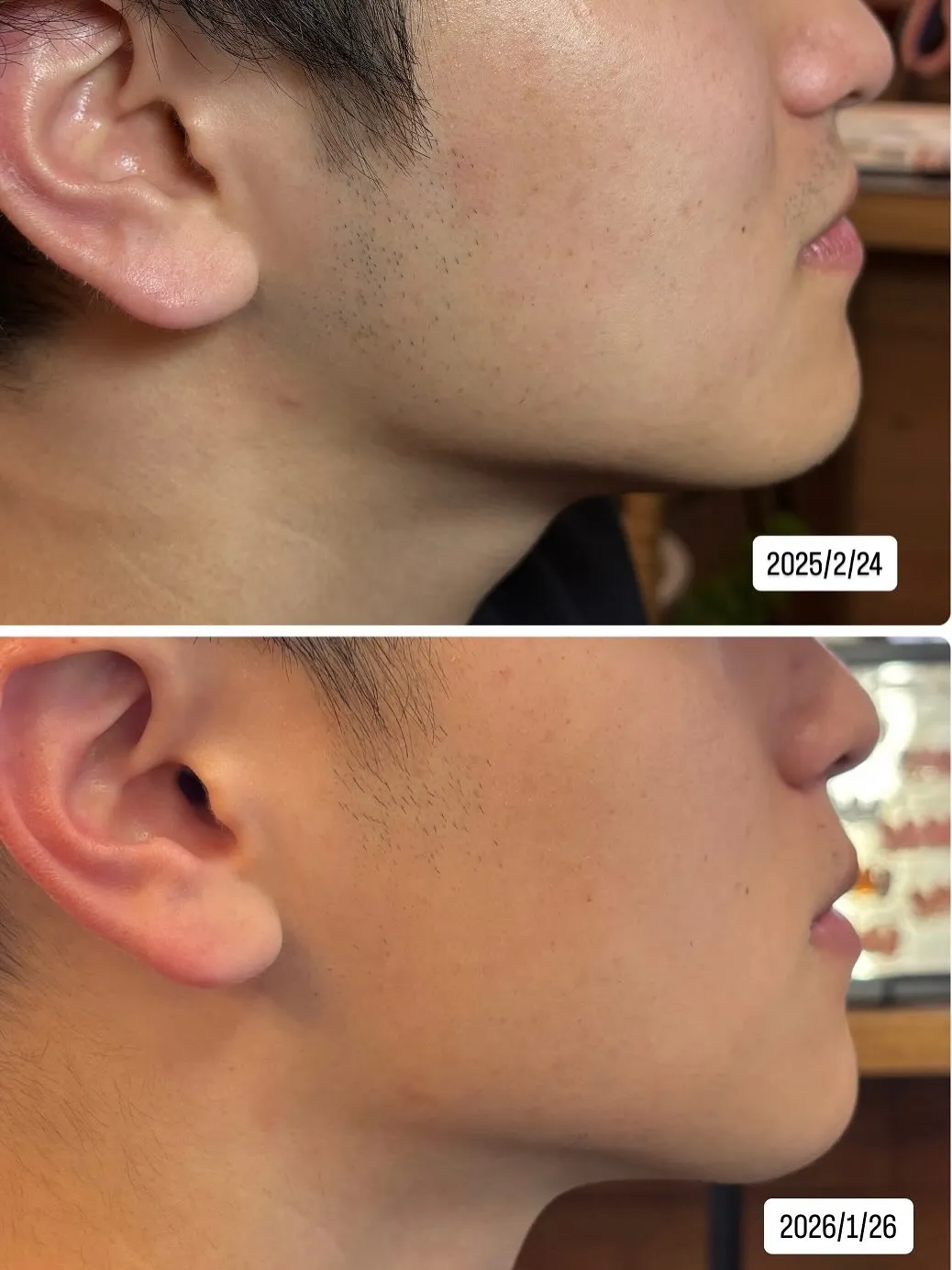 約1年後こうなりました‼️