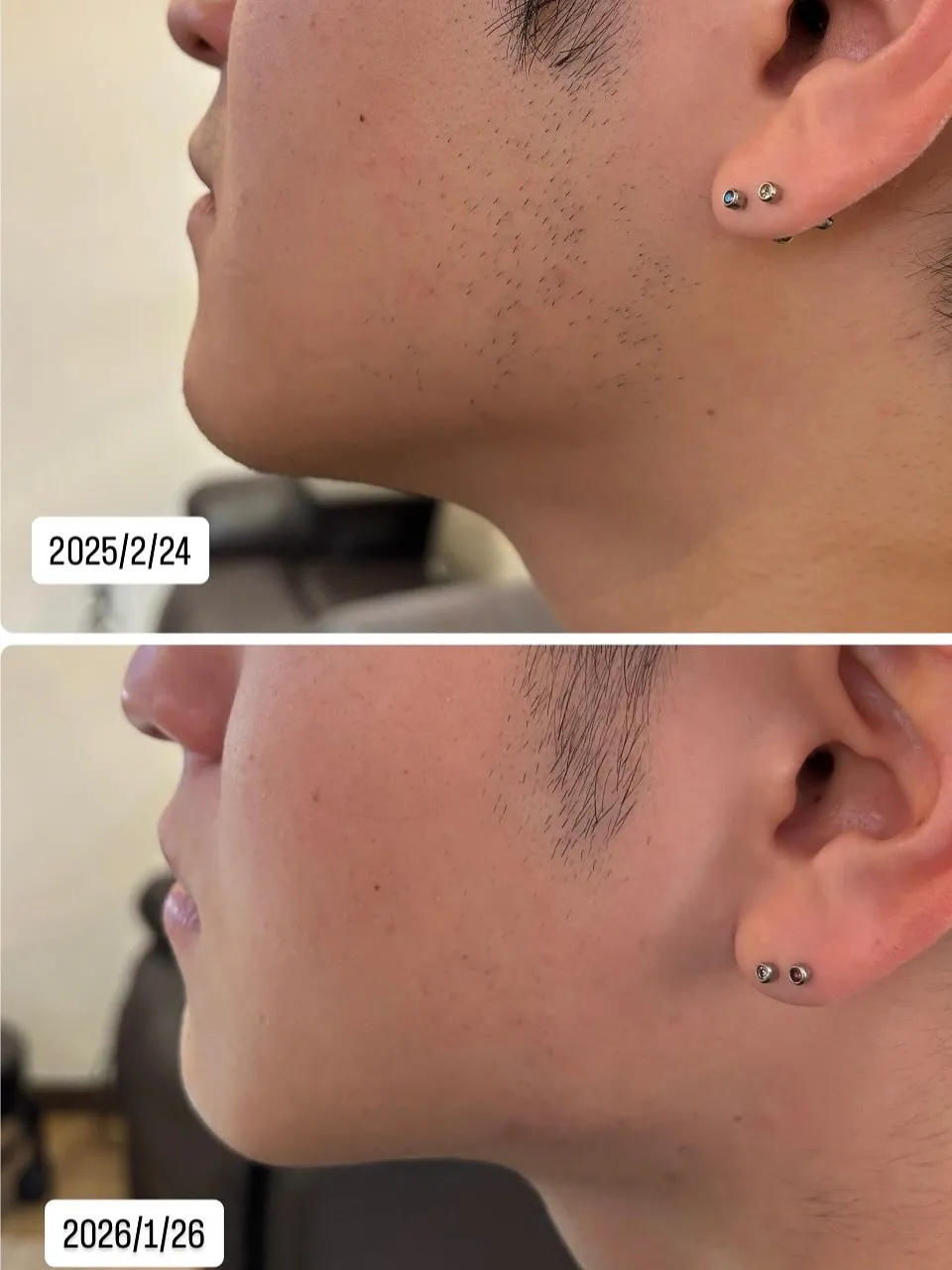 約1年後こうなりました‼️